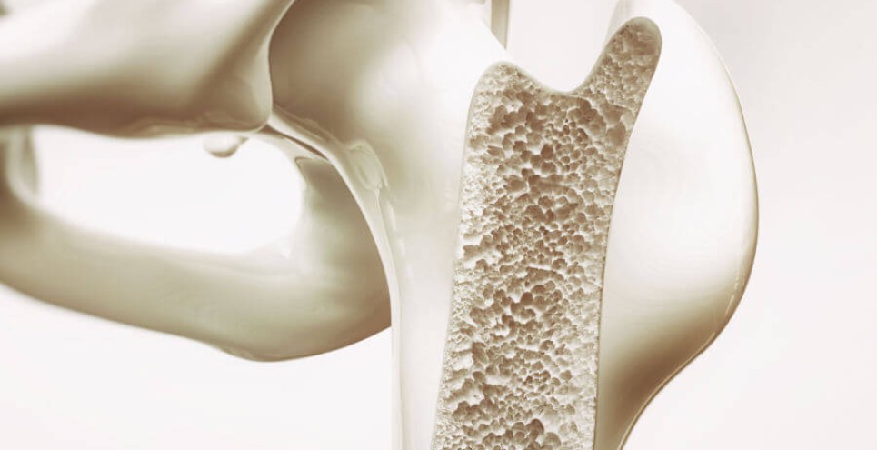 Osteoporosi: sintomi e trattamento